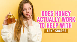 How to Remove Acne Scars Naturally