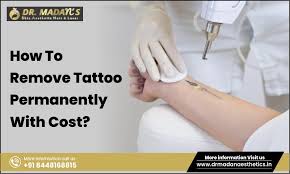 How Much Does It Cost to Remove a Tattoo