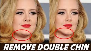 How to Remove a Double Chin